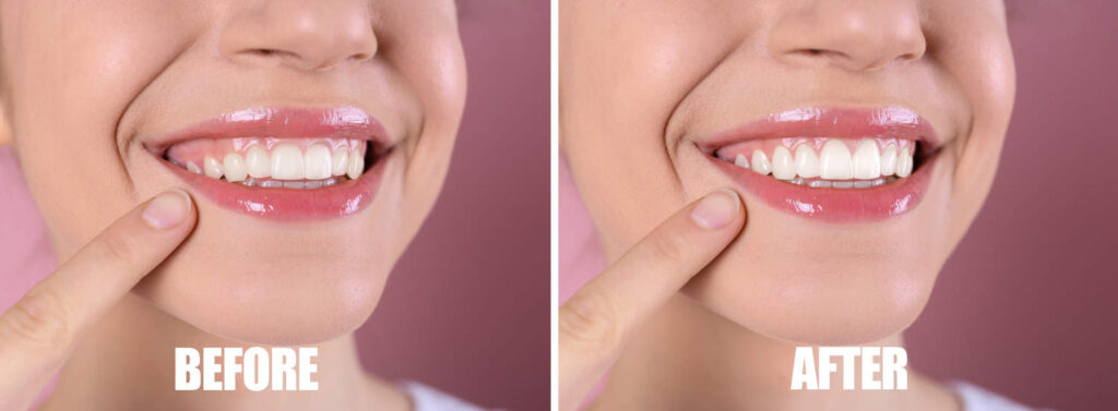 Teeth Whitening | Bloor Smile Dental