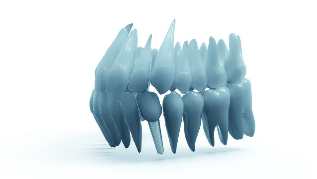 Dental Implants | Toronto Cosmetic Dentistry