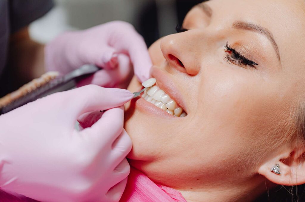 What Happens to Your Natural Teeth Under Dental Veneers? The Dentist’s Perspective